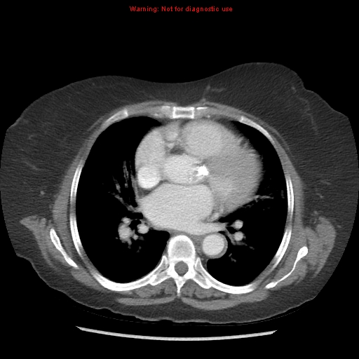 File:Aortic valve stenosis (Radiopaedia 14480-14423 C 5).jpg