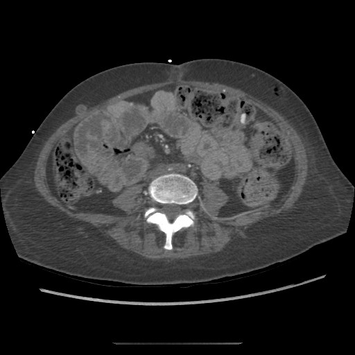 Aorto-duodenal fistula (Radiopaedia 25668-25850 A 48).jpg