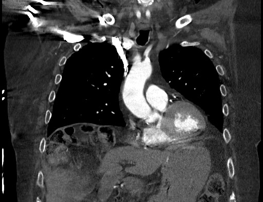 Aortoesophageal fistula with endovascular repair (Radiopaedia 73781-84592 Coronal C+ CTPA 40).jpg