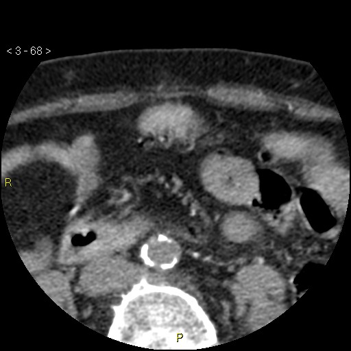File:Aortoiliac occlusive disease (Radiopaedia 16828-16548 A 68).jpg