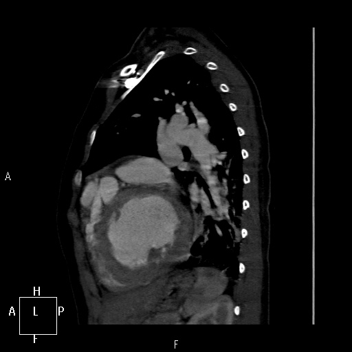 File:Aortopulmonary septal defect (Radiopaedia 41990-45013 Sagittal C+ CTPA 11).jpg