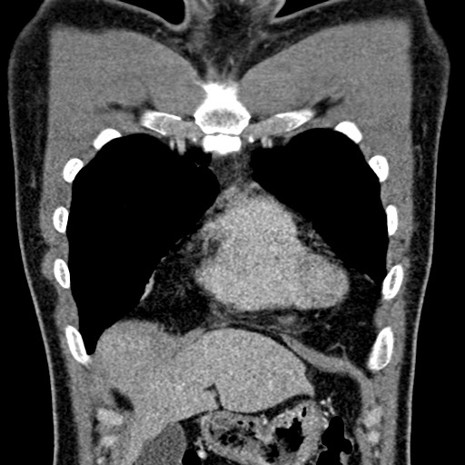 File:Apical lung mass mimic - neurogenic tumor (Radiopaedia 59918-67521 B 40).jpg