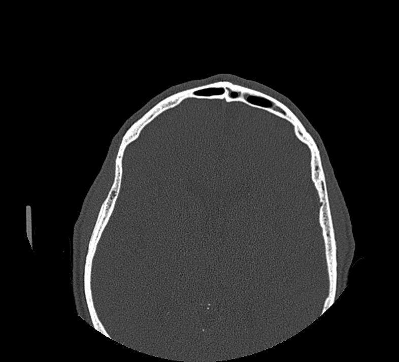Aplastic maxillary sinuses (Radiopaedia 60030-67561 Axial non-contrast 71).jpg