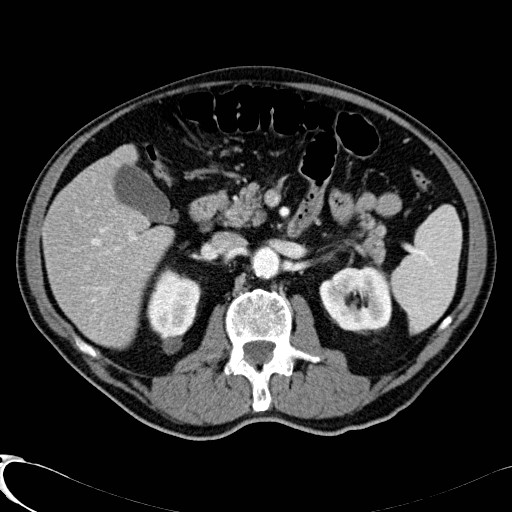 File:Appendiceal adenocarcinoma complicated by retroperitoneal abscess (Radiopaedia 58007-65039 B 51).jpg