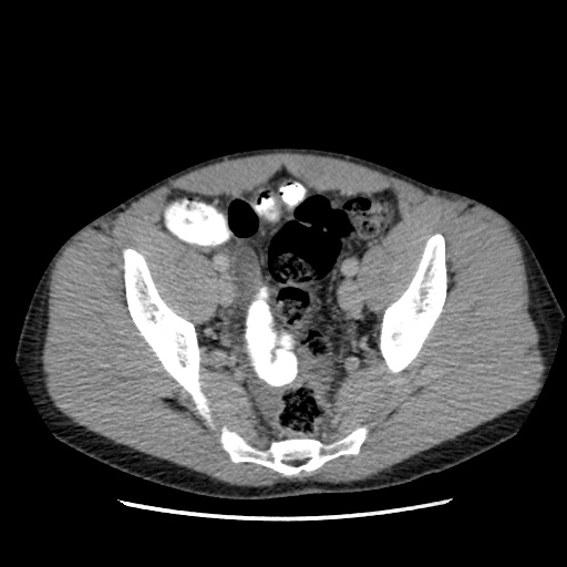 Appendicitis complicated by post-operative collection (Radiopaedia 35595-37113 A 64).jpg