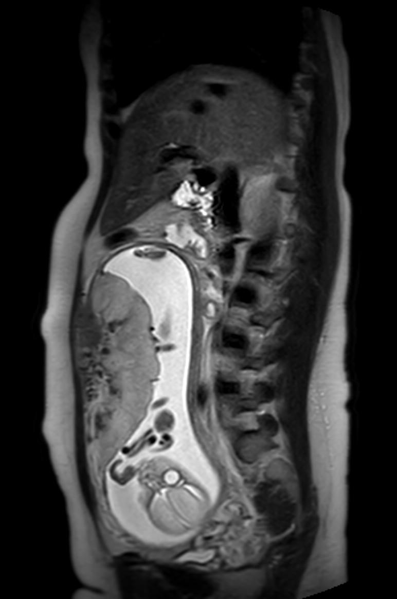 Appendicitis in gravida (MRI) (Radiopaedia 89433-106395 Sagittal T2 38).jpg