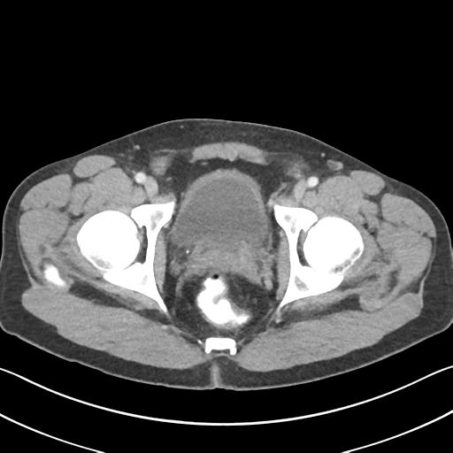 File:Appendicitis with cecal bar sign (Radiopaedia 31878-32830 B 77).jpg