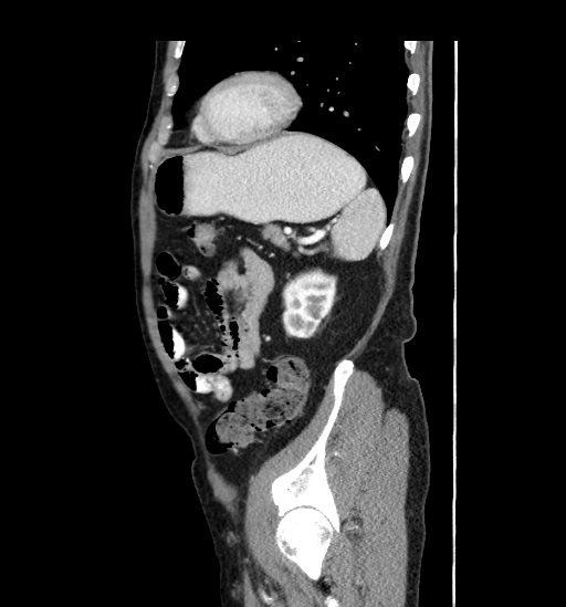 Appendicitis with localized perforation and abscess formation (Radiopaedia 49035-54130 C 50).jpg