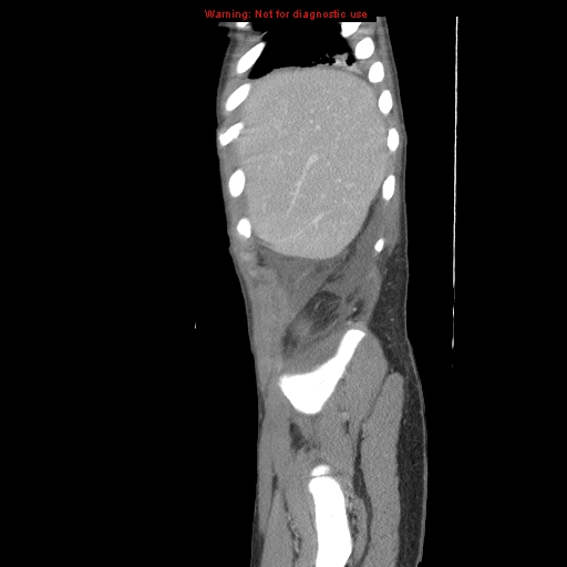 File:Appendicitis with phlegmon (Radiopaedia 9358-10046 F 1).jpg