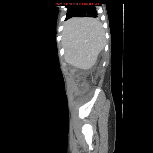 File:Appendicitis with phlegmon (Radiopaedia 9358-10046 F 3).jpg