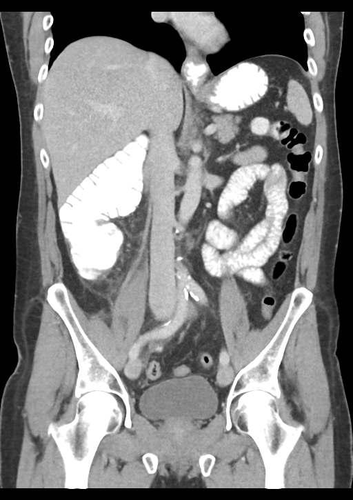 Appendicitis with thickening of the terminal ileum (Radiopaedia 42432-45550 B 31).png