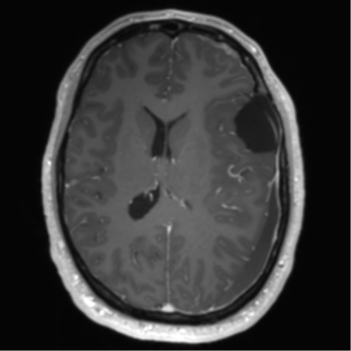 File:Arachnoid cyst with subdural hematoma (Radiopaedia 85892-101743 Axial T1 C+ 51).png