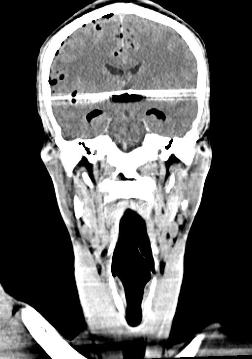 Arrow injury to the brain (Radiopaedia 72101-82607 Coronal non-contrast 41).jpg
