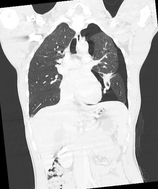 Arrow injury to the chest (Radiopaedia 85367-100975 Coronal lung window 73).jpg