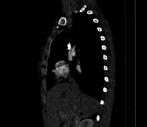 Arteria lusoria (Radiopaedia 88528-105192 C 41).jpg