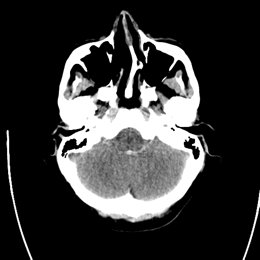 File:Arteriovenous malformation (cerebral) (Radiopaedia 40070-42579 Axial non-contrast 7).png