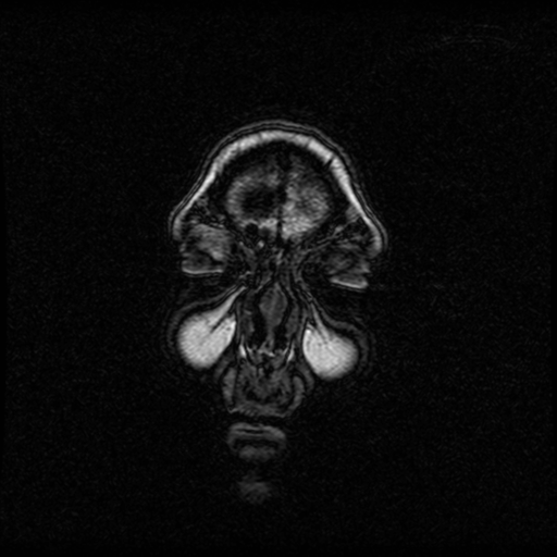 File:Arteriovenous malformation (cerebral) (Radiopaedia 40070-42580 Coronal T1 60).png