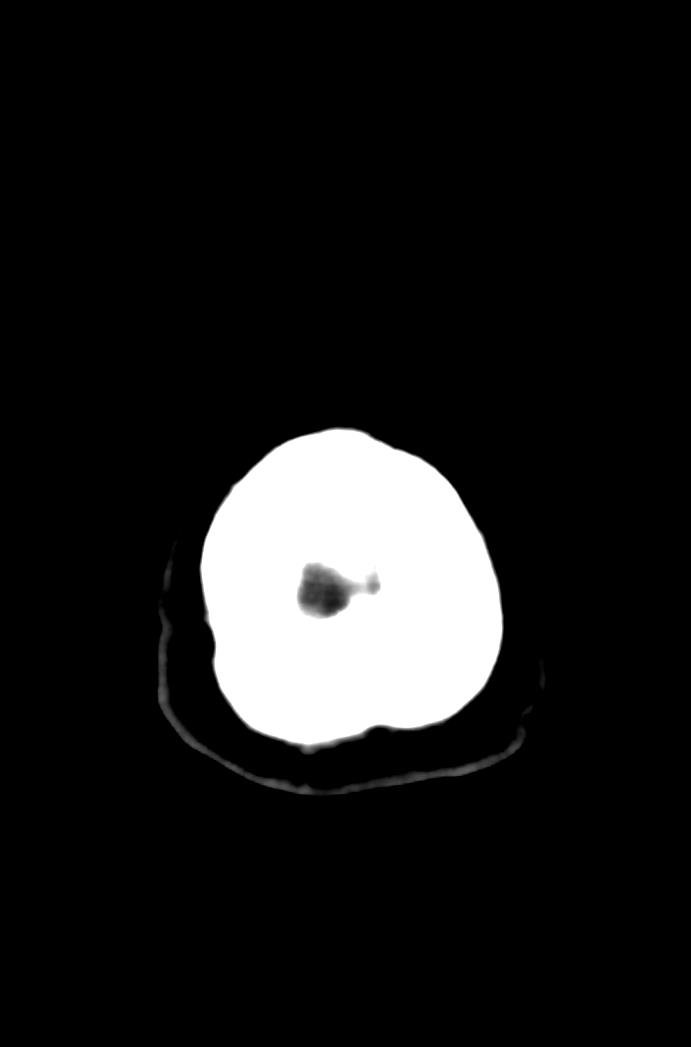 Artery of Percheron infarction (Radiopaedia 80613-94202 Axial non-contrast 189).jpg