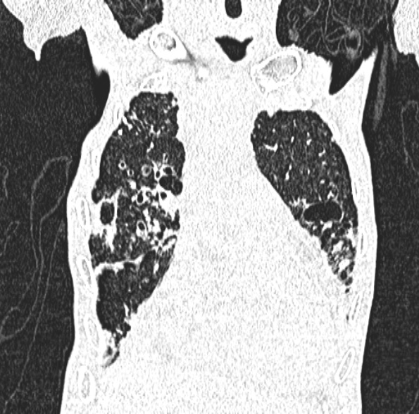 Aspergilloma- with Monod sign (Radiopaedia 44737-48532 Coronal lung window 168).jpg