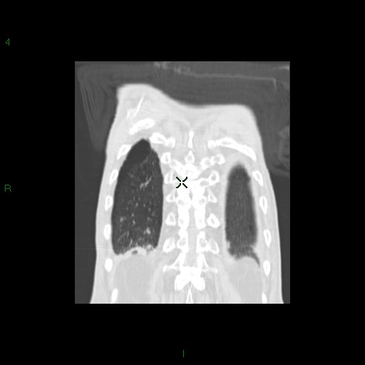File:Aspergilloma (Radiopaedia 14842-14787 Coronal lung window 33).jpg