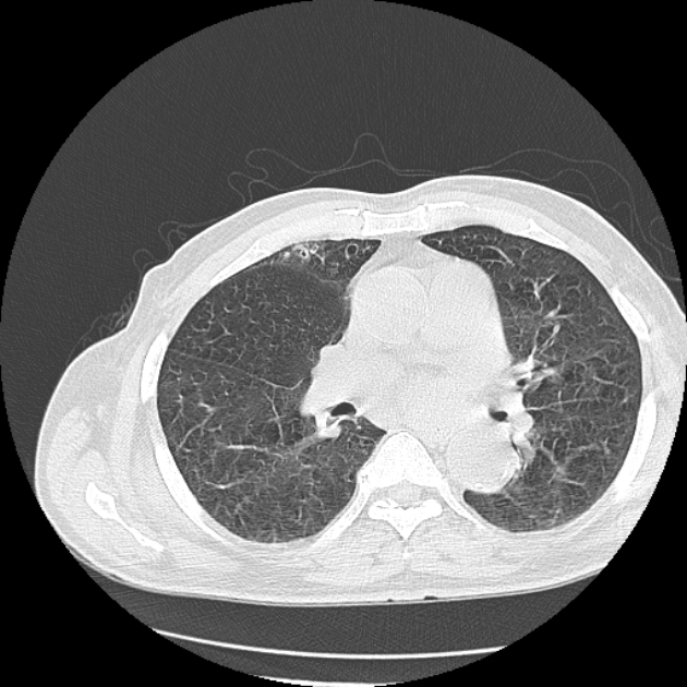 Aspergilloma (Radiopaedia 44592-48327 Axial lung window 43).jpg
