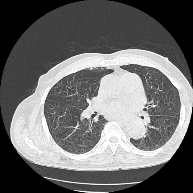 Aspergilloma (Radiopaedia 44592-48327 Axial lung window 46).jpg