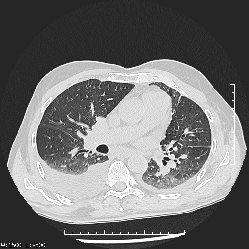 Aspergilloma (Radiopaedia 75184-86270 Axial lung window 25).jpg