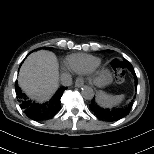 Aspergilloma on background pulmonary fibrosis (Radiopaedia 60942-68757 Axial non-contrast 46).jpg