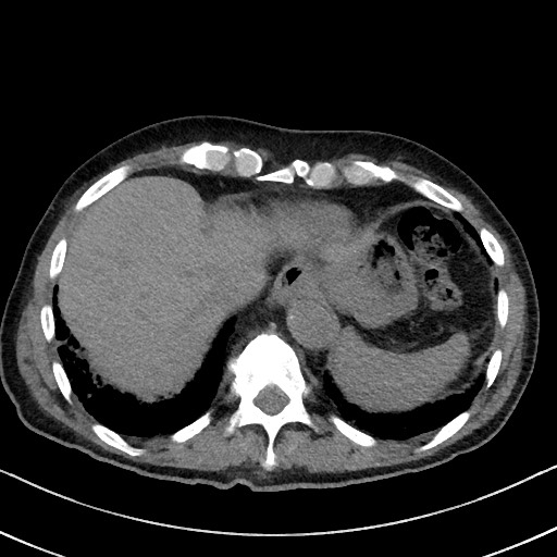 Aspergilloma on background pulmonary fibrosis (Radiopaedia 60942-68757 Axial non-contrast 48).jpg