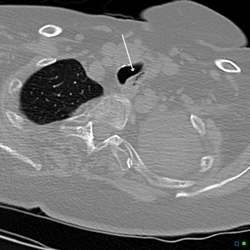 File:Aspirated food bolus obstruction of left main bronchus (Radiopaedia 29432-29904 Axial non-contrast 1).jpg