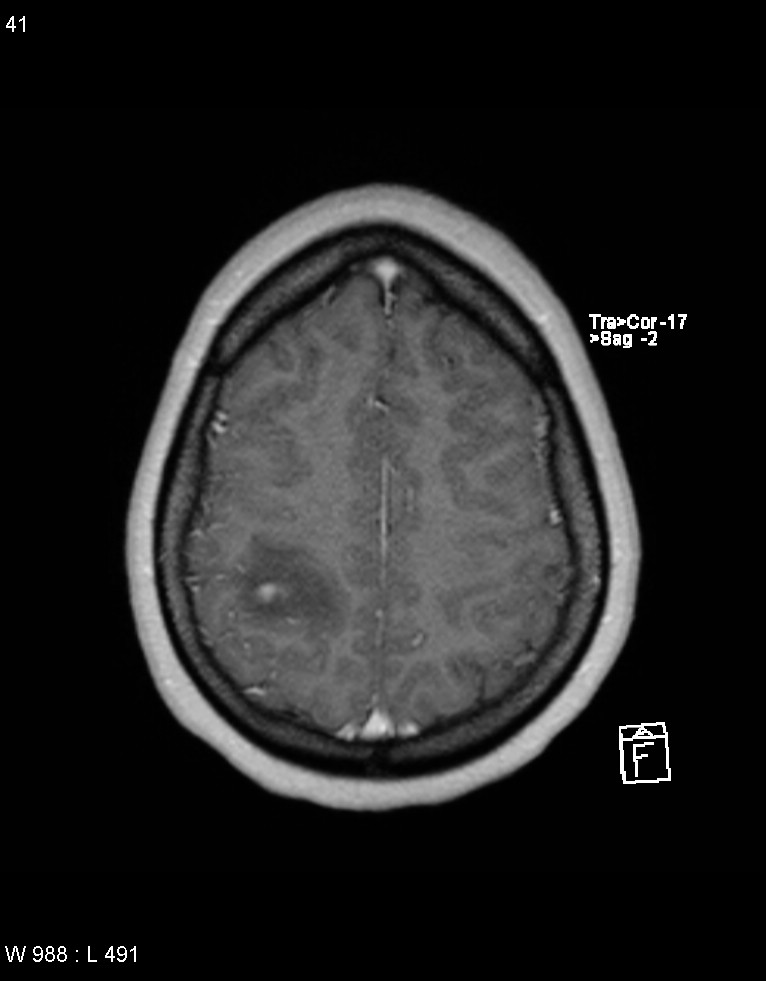 Astroblastoma (Radiopaedia 39792-42217 Axial T1 C+ 40).jpg