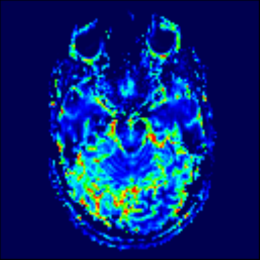 File:Astrocytoma, IDH-mutant - grade 3 (Radiopaedia 50046-55341 Axial 231).png