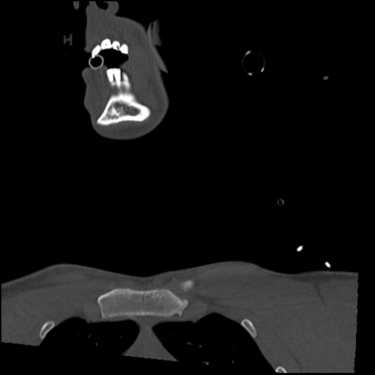Atlanto-occipital dissociation (Traynelis type 1), C2 teardrop fracture, C6-7 facet joint dislocation (Radiopaedia 87655-104061 Coronal bone window 2).jpg