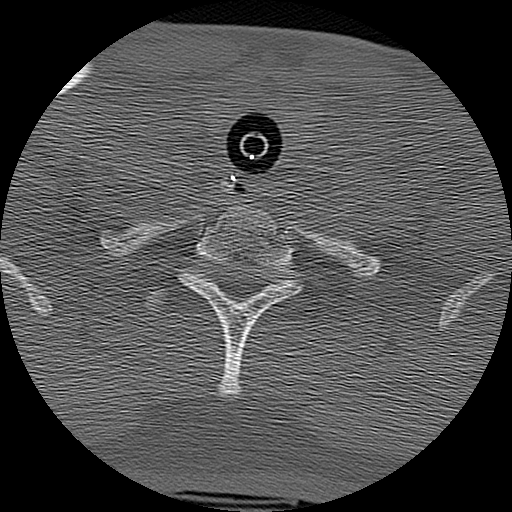 Atlanto-occipital dissociation injury (Radiopaedia 29274-29698 Axial bone window 72).png