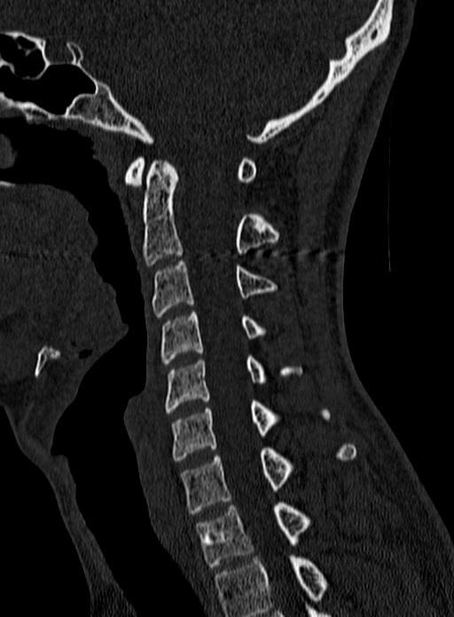 Atlantoaxial subluxation (Radiopaedia 44681-48450 Sagittal bone window 67).jpg