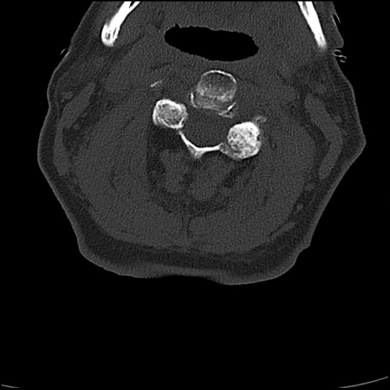 File:Atlas (type 3b subtype 1) and axis (Anderson and D'Alonzo type 3, Roy-Camille type 2) fractures (Radiopaedia 88043-104607 Axial bone window 29).jpg