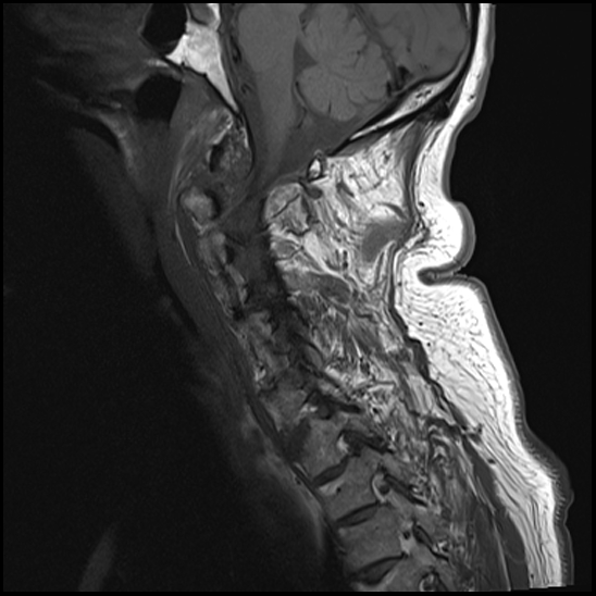 File:Atlas (type 3b subtype 1) and axis (Anderson and D'Alonzo type 3, Roy-Camille type 2) fractures (Radiopaedia 88043-104610 Sagittal T1 3).jpg