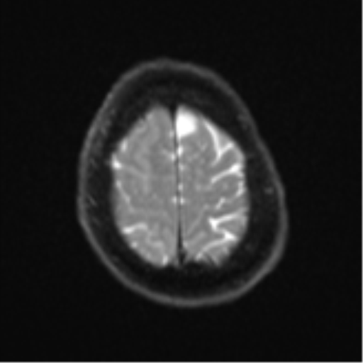 File:Atypical meningioma (WHO Grade II) (Radiopaedia 54742-60981 Axial DWI 24).png