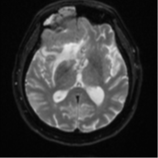 Atypical meningioma (WHO grade II) with brain invasion (Radiopaedia 57767-64729 Axial DWI 15).png