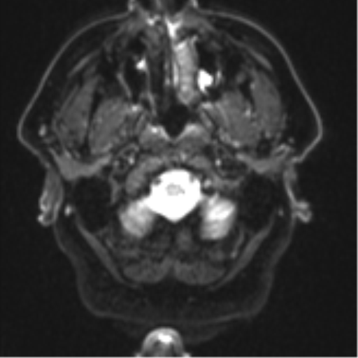 File:Atypical meningioma (WHO grade II) with brain invasion (Radiopaedia 57767-64729 Axial DWI 2).png