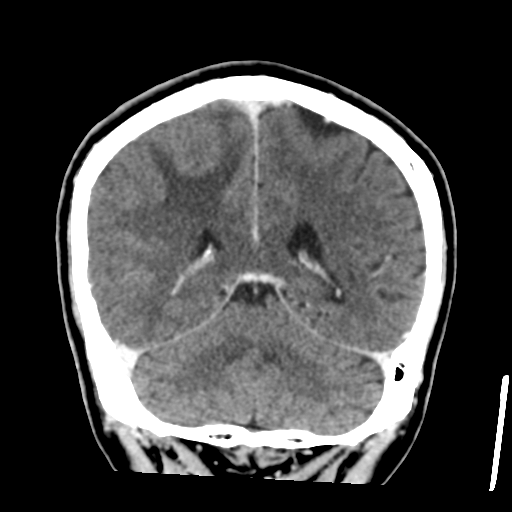 Atypical meningioma (WHO grade II) with osseous invasion (Radiopaedia 53654-59715 Coronal C+ delayed 42).png