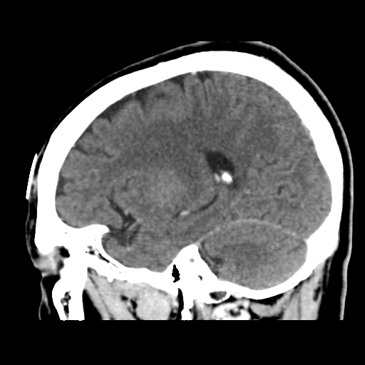 Atypical meningioma (WHO grade II) with osseous invasion (Radiopaedia 53654-59715 G 37).png