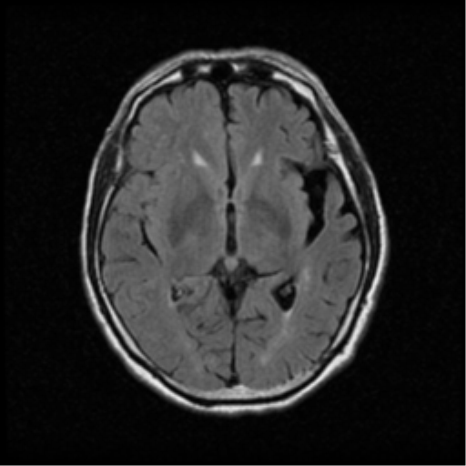 File:Atypical meningioma with skull invasion (Radiopaedia 34357-35648 Axial FLAIR 11).png