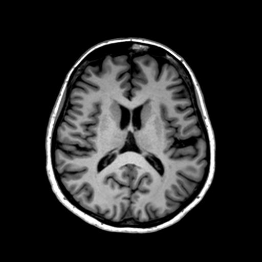 Autoimmune limbic encephalitis (Radiopaedia 30363-31005 T1 Axial 1mm 88).jpg