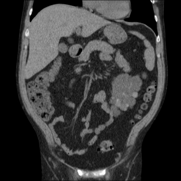 Autosomal dominant polycystic kidney disease (Radiopaedia 36539-38101 C 26).jpg