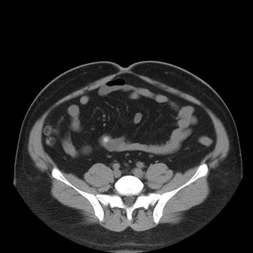 Autosomal dominant polycystic kidney disease (Radiopaedia 50259-55612 Axial non-contrast 60).jpg