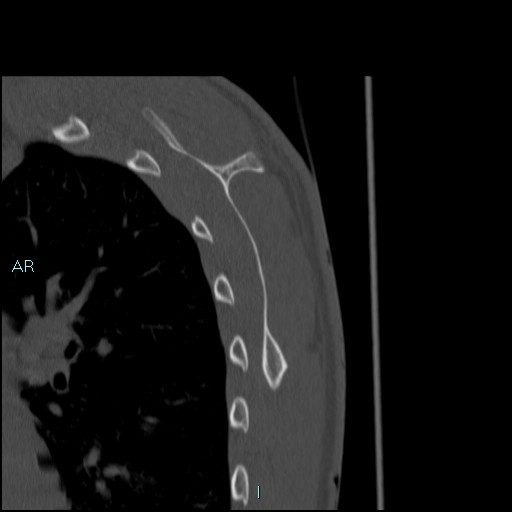 Avascular necrosis after fracture dislocations of the proximal humerus (Radiopaedia 88078-104653 Sagittal bone window 71).jpg