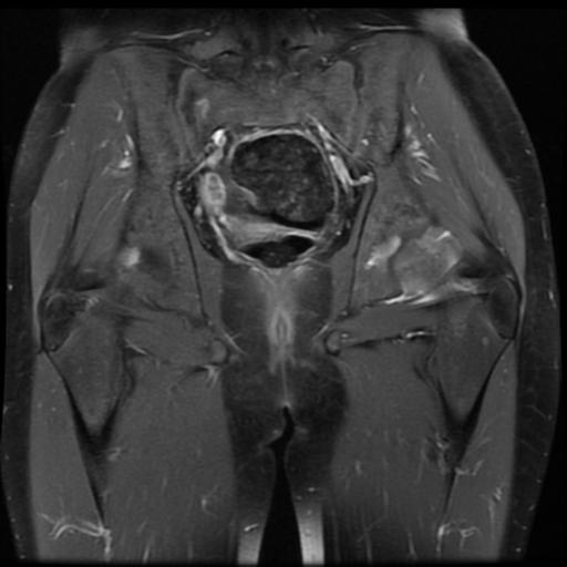 File:Avascular necrosis of the hip (Radiopaedia 29563-30067 I 11).jpg