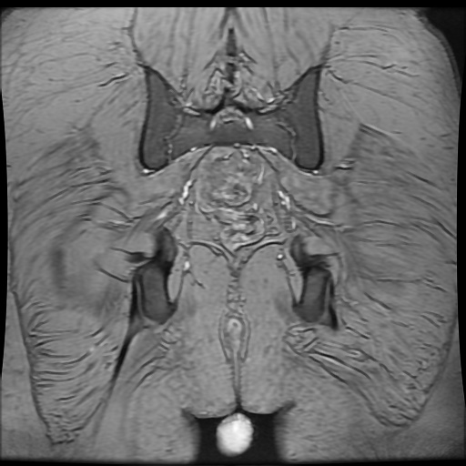Avascular necrosis of the hip (Radiopaedia 61503-69465 F 89).jpg