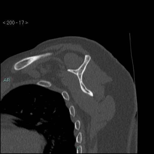 Avascular necrosis of the shoulder - Cruess stage I (Radiopaedia 77674-89887 Sagittal bone window 16).jpg